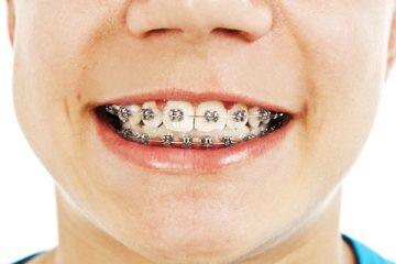 How do I know if I need braces
