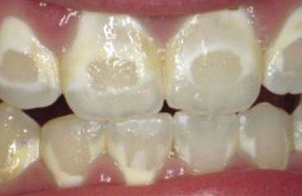 Can You Drink Soda While Wearing Braces Can You Drink Soda While Wearing Braces