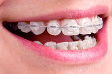 Metal, Clear and Ceramic Braces. What's the Difference?