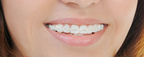 Clear / Ceramic Braces