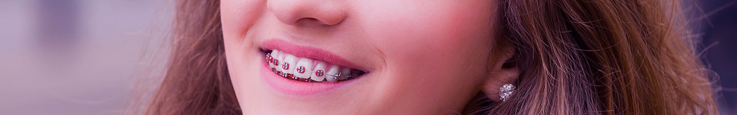 Types Of Braces