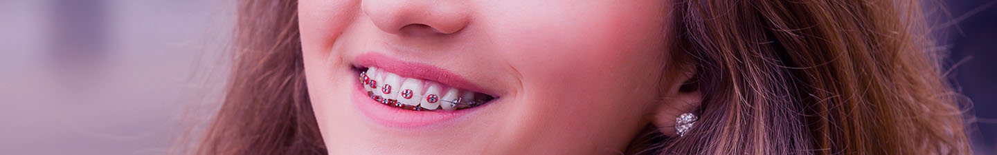 Types Of Braces