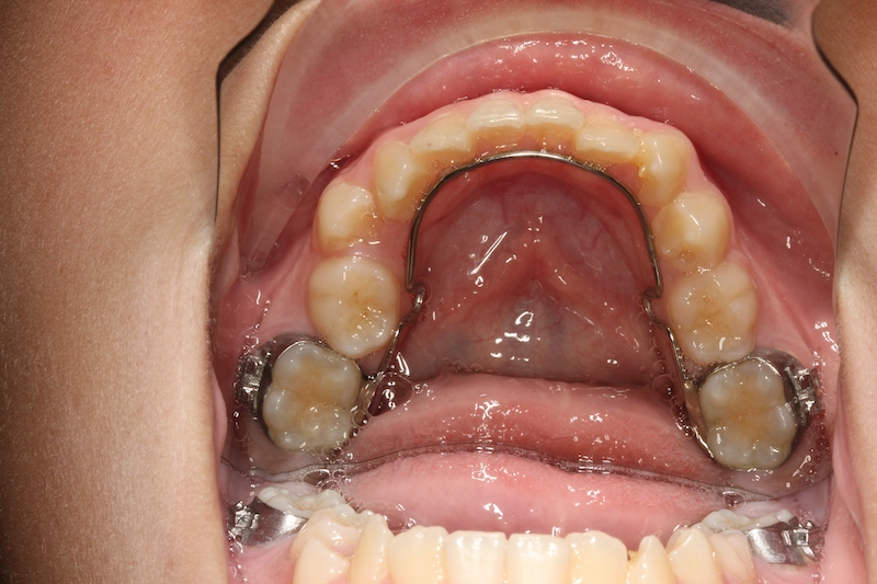 lower lingual holding arch