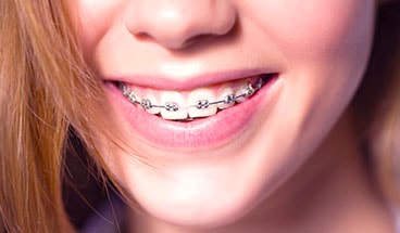 Types Of Braces